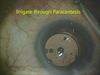 Retained Lens Particles by Preventive Irrigation of the Paracentesis