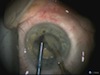 BMICS in a Patient with Fuchs dystrophy, Dense Cataract and IFIS