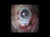 Brunescent Cataract Pseudoexfoliation