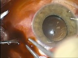Choroidal Hemorrhage After 23-Gauge Vitrectomy