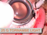 Bimanual surgery using new generation chandelier systems