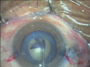 The Blue Pearl - Safe Technique for Staining the Capsule