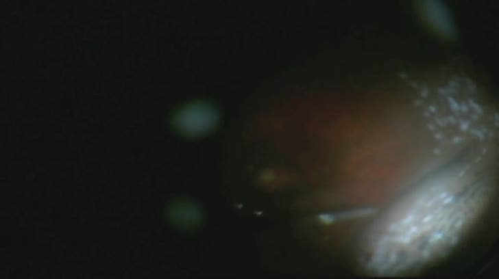 Suprachoroidal Buckling With an Olive-shaped 25-gauge Cannula