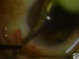 Absent Posterior Capsule