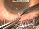 Trabeculectomy with Mitomycin C Left Eye