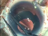 Glued Iris Prosthesis