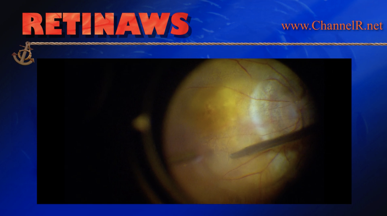 Retinal Detachment and High Myopia