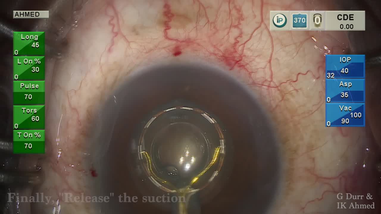 Cataract Surgery with Zepto and MIGS