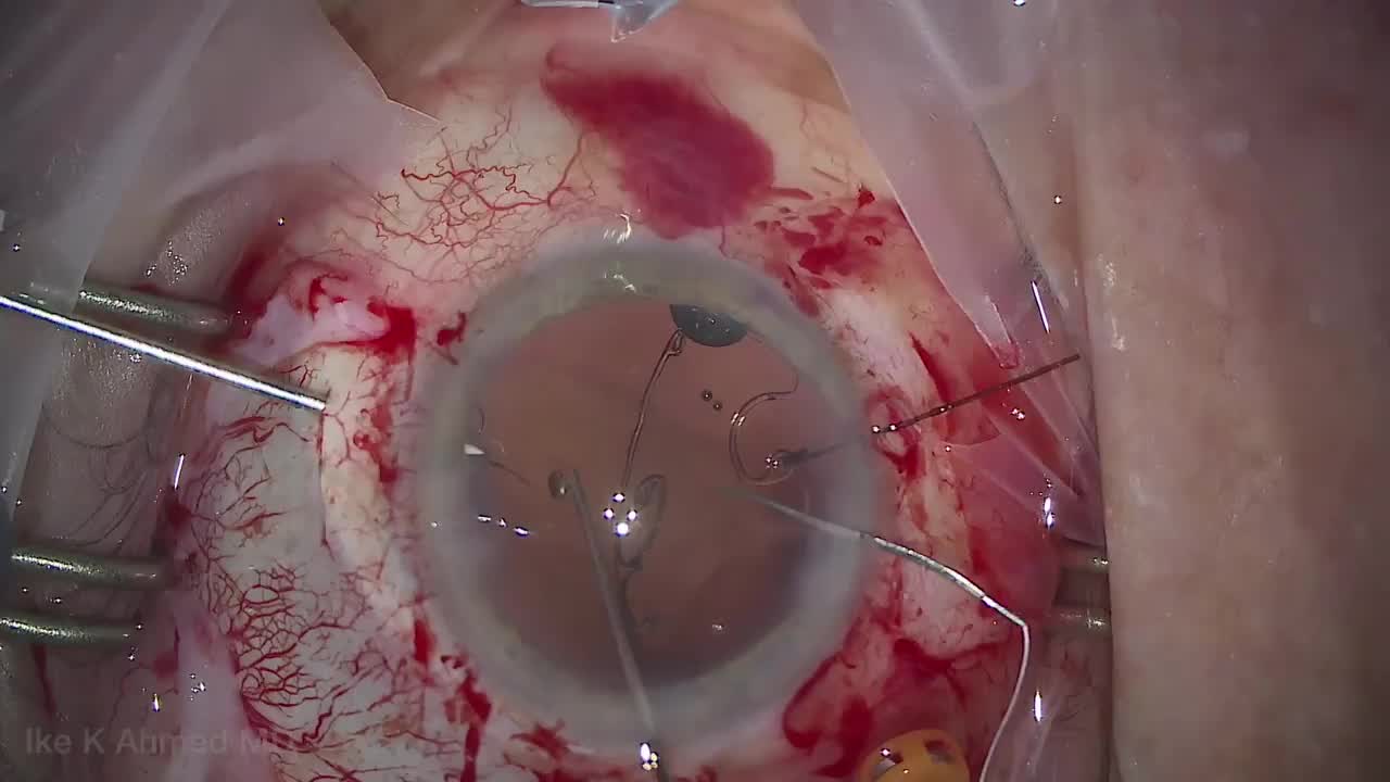 Severe Traumatic Cataract Dislocation, Atonic Pupil and Glaucoma