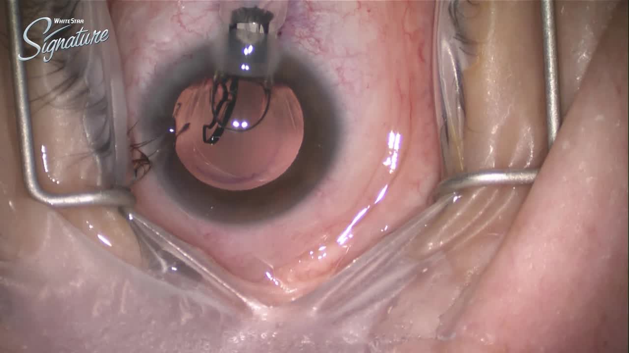 IC-8 Lens Procedure