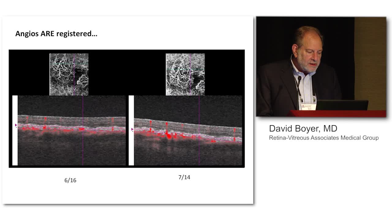 OCT-A for Identifying CNV in Patients with Type 1 AMD and Assessing Response to anti-VEGF treatment