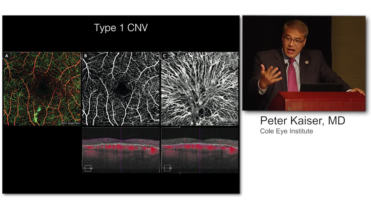 OCT-A for the Detection of CNV in Types I, II, III and PCV CNV