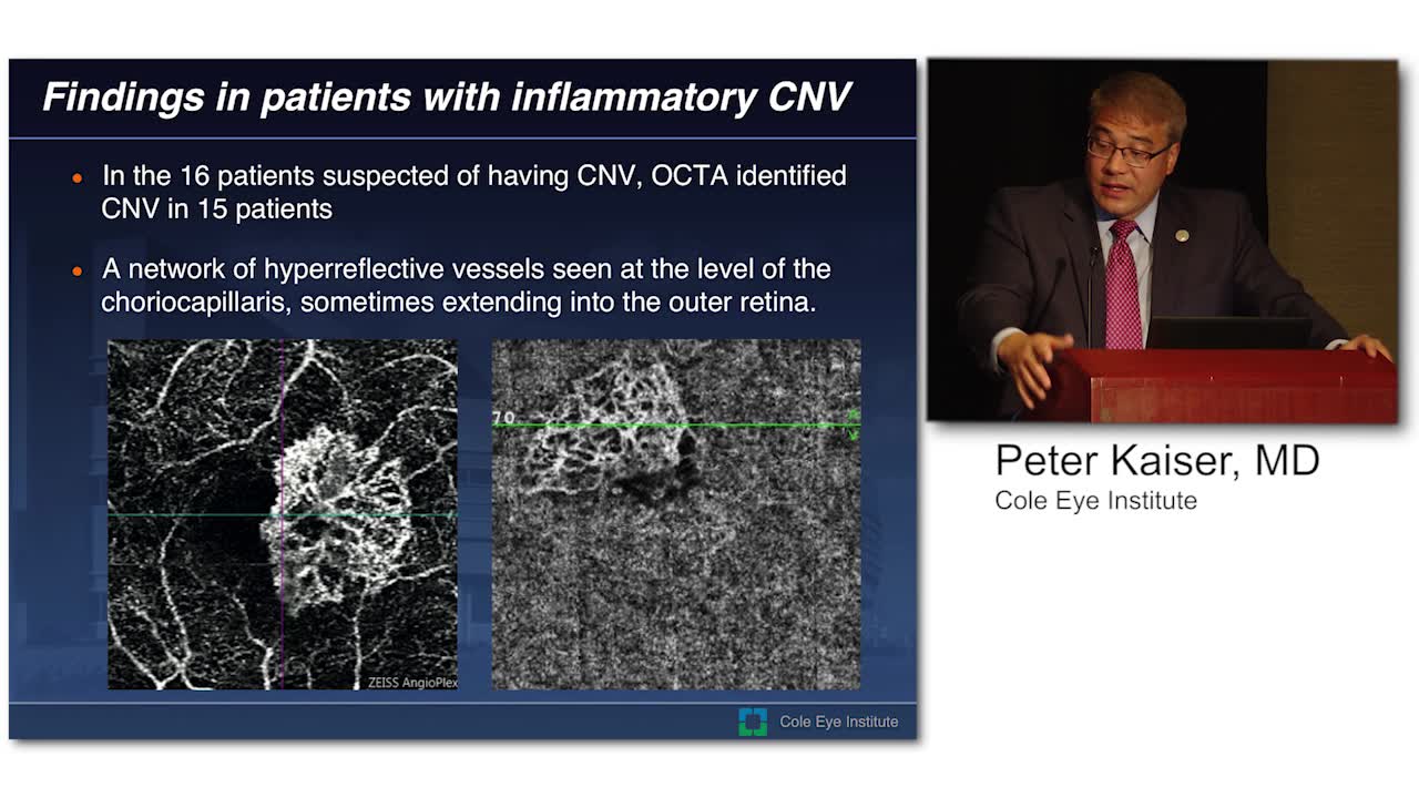 OCT Angiography in Uveitic Choroidal Neovascularization: Will it Replace Fluorescein Angiography?