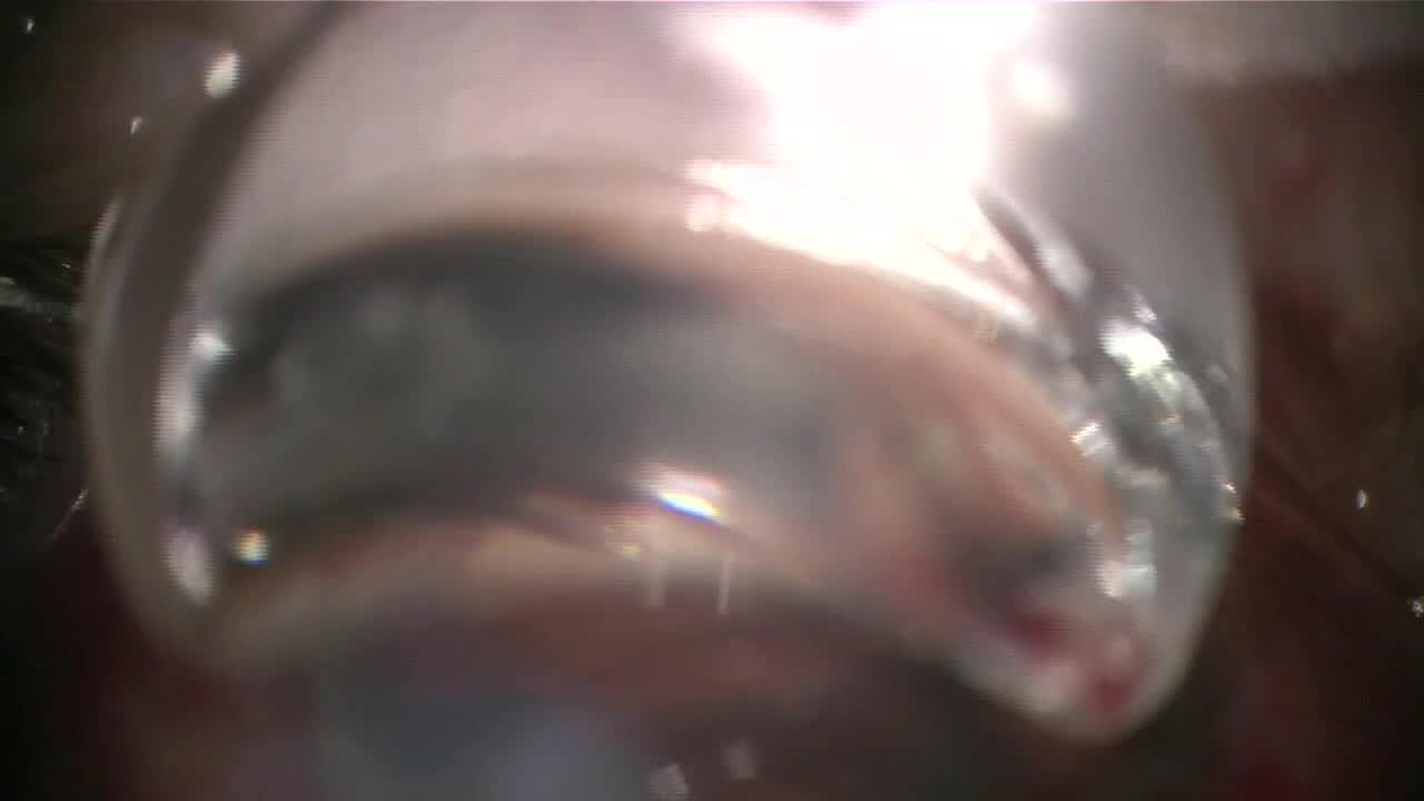 180-Degree Viscodilation Using the Omni System and Hydrus Implantation