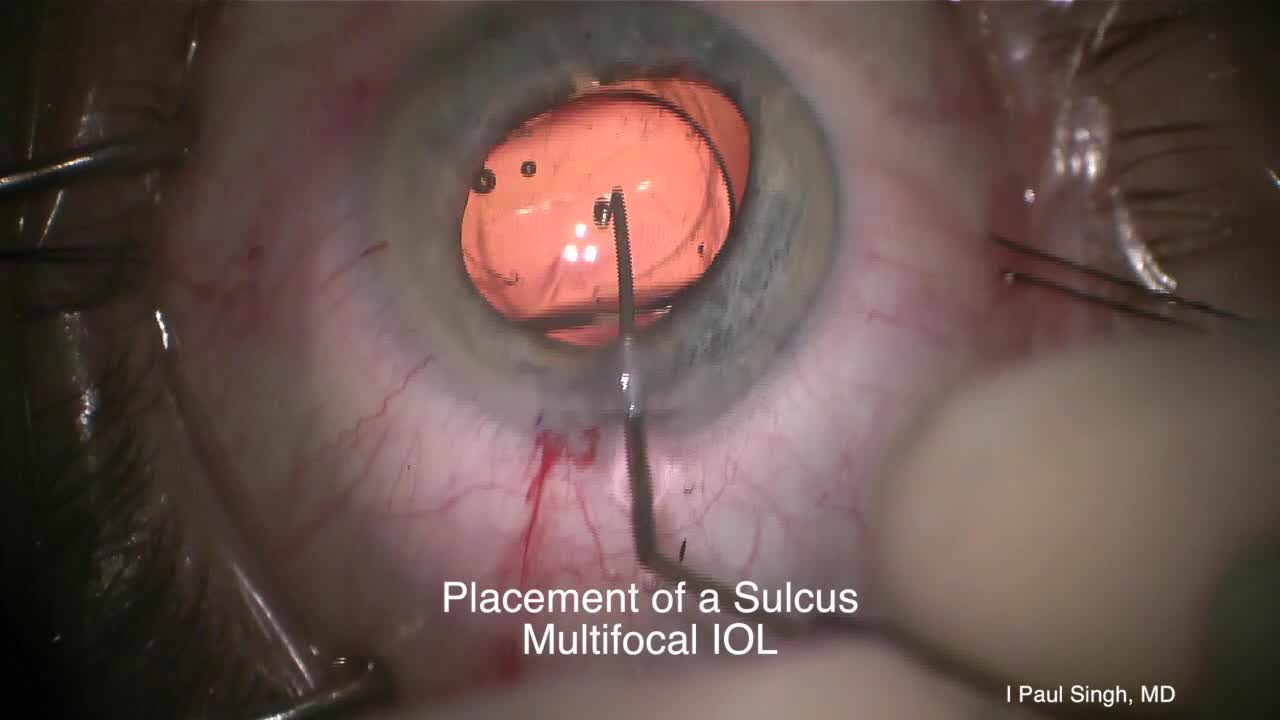 Use of CALLISTO eye to Verify the Centration of a Multifocal Lens Exchange