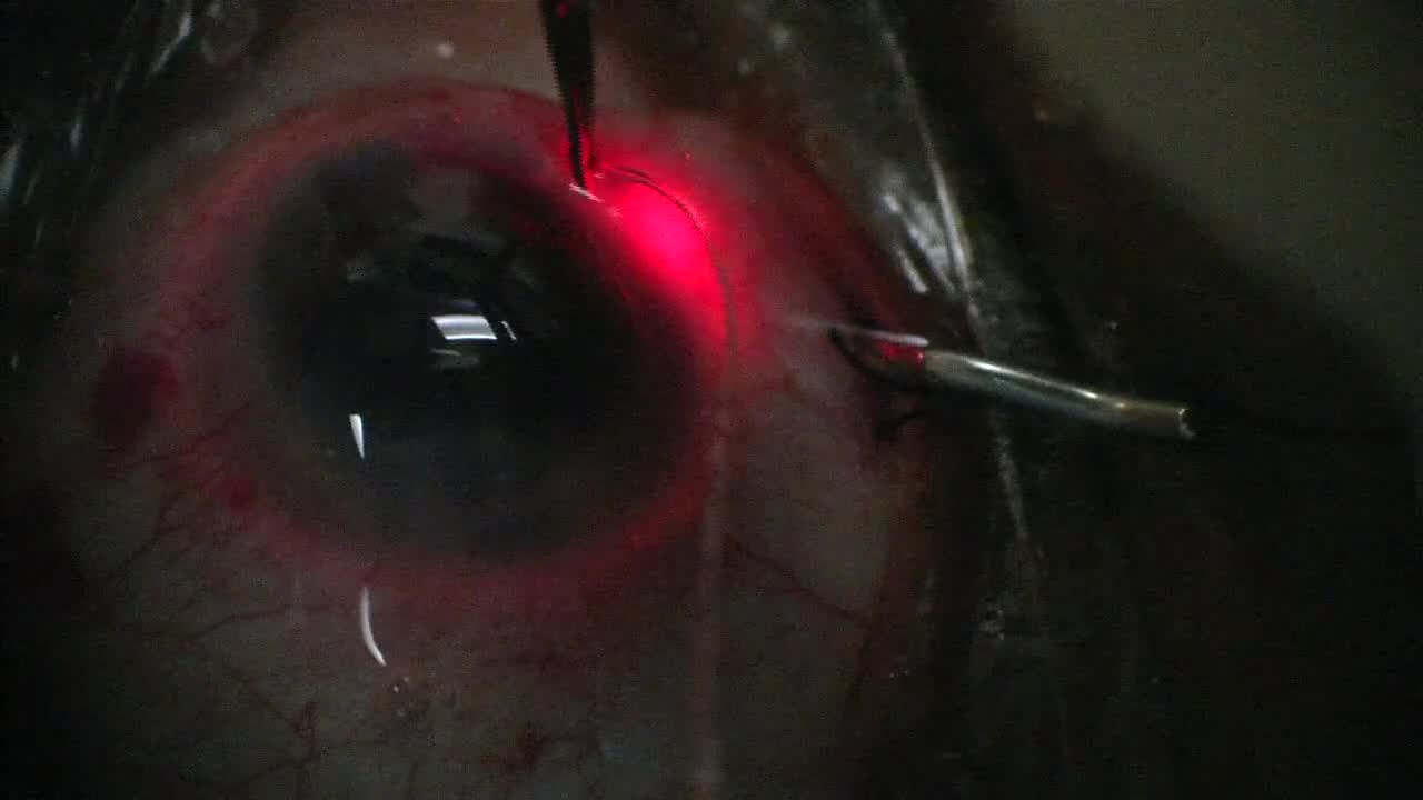 ABiC with External Advancement of the Catheter