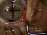 Boston Keratoprosthesis Implantation