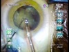 Cataract Surgery in a Vitrectomized Eye