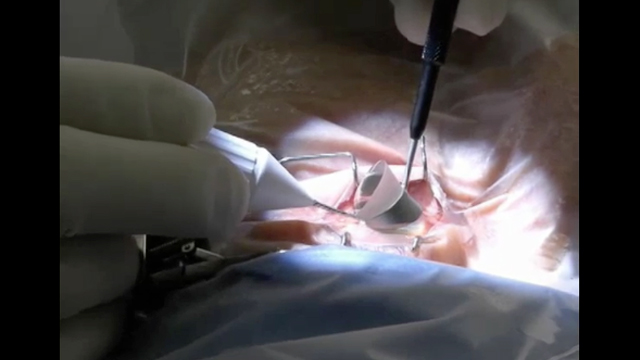Cataract Surgery and MIGS