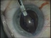 Malyugin Ring with Healon 5