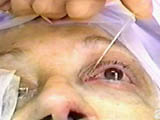 Implantation of Transnasal Lacrimal Stent