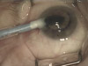 Descemets Membrane Endothelial Keratoplasty (DMEK)
