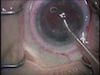 CXL Intacs in a Complex Case