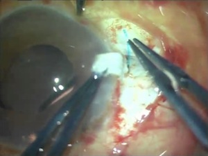 Live Surgery of Glued IOL