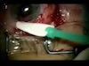 ReSure Adherent Ocular Bandage to Prevent Leakage after Filtrating Glaucoma Surgery