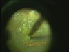 TRIAM...TIME: Triamcinolone-Assisted Vitrectomy