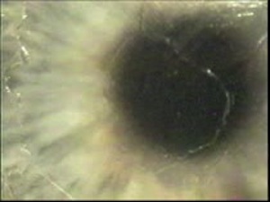 Button Hole LASIK Complication Corrected to 20/20