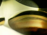 Visualization of Narrow Angle with Indentation Gonioscopy