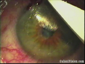 Myopic Laser PRK for Chemical Burn Scar