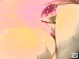 Treatment of Lacrimal Punctum Stenosis