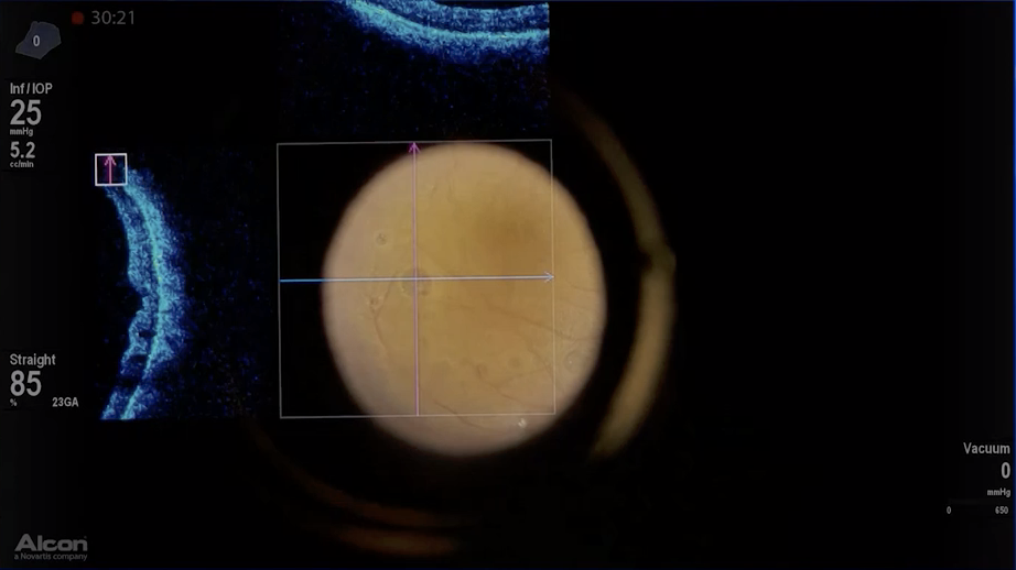 Subretinal Perfluoron - Eyetube