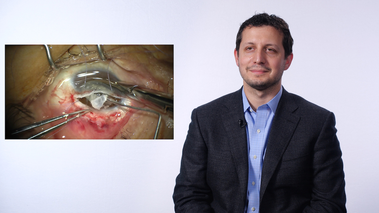 Extracapsular Extraction of Long-standing Traumatic Cataract