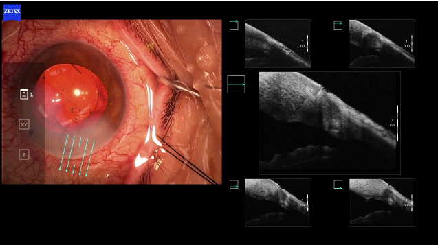 Xen Implantation Using ReScan Intraoperative OCT