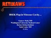 DSEK Flap in Vitreous Cavity