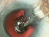 Implantation of the Visiogen Synchrony