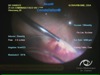 Retinal Detachment - à chaud