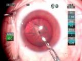 Microcoaxial Phaco Surgery 