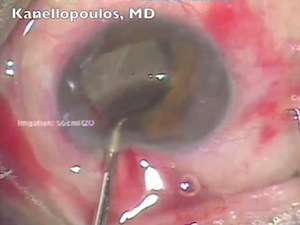 IOL Exchange and DSAEK