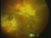 Illuminated Vitreous Cutter