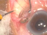 Trypan Blue Assisted Micro-Incision Vitrectomy Surgery