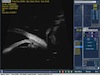 Ciliary Cyst - Part 1