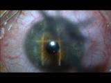 Epi-LASIK 
