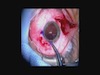 Definitive Surgical Repair of A Traumatic Cyclodialysis Cleft