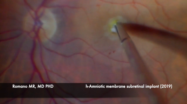 Human Amniotic Membrane Subretinal Implant in Large Refractory Macular Hole