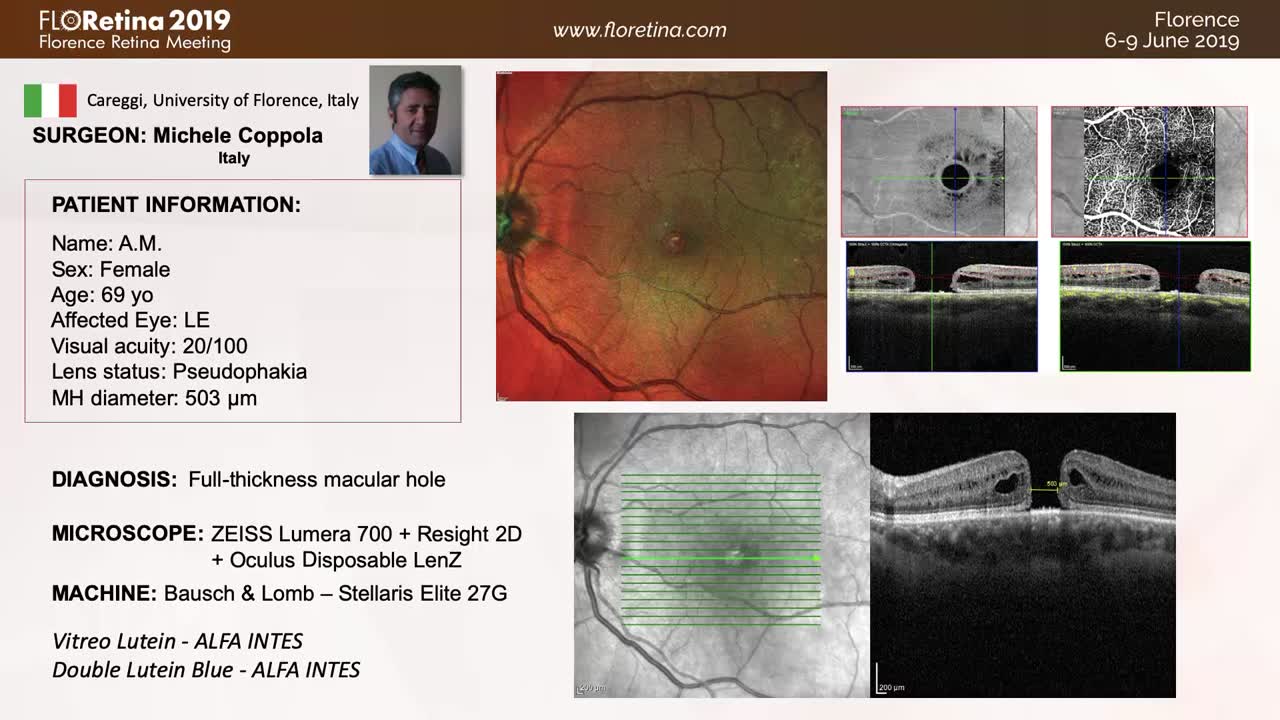 [3D] Techniques for Full-Thickness Macular Hole