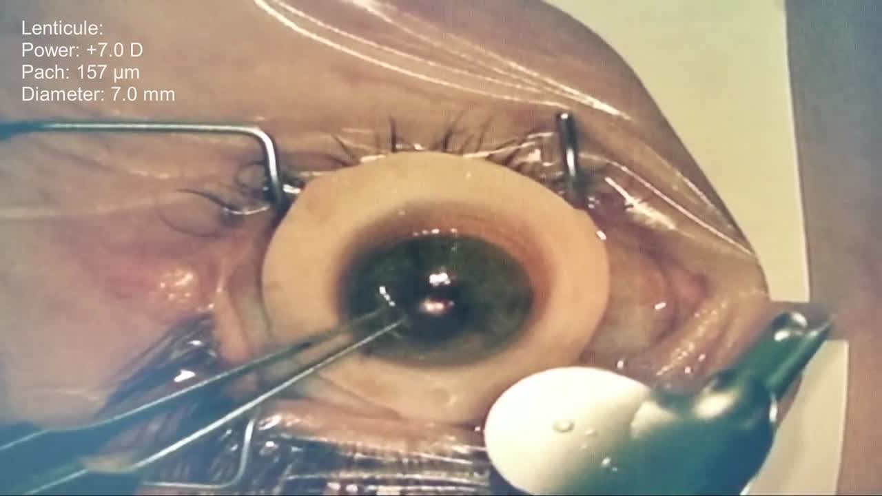 LIKE (Lenticular Intrastromal Keratoplasty) Procedure
